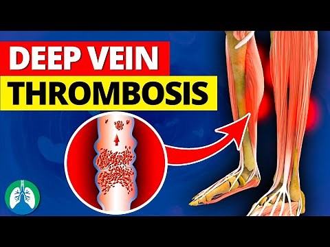 Deep Vein Thrombosis (DVT) | Quick Medical Overview