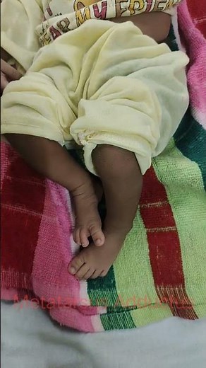 Metatarsus Adductus:: Diff Diag of CTEV foot