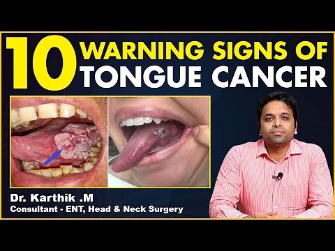 10 Warning Signs of Tongue Cancer || Signs Of Oral Cancer || Dr Karthik || TX Hospitals