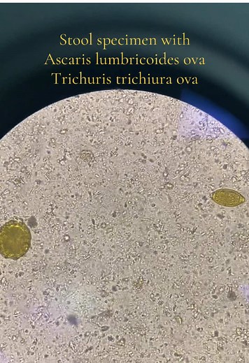 Understanding Stool Specimens: Parasites Under the Microscope