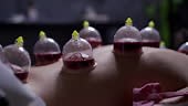 Wet cupping involve suction and controlled medicinal bleeding....