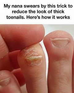 The Tried-and-True Trick for Reducing Thick Toenails | Easy craft