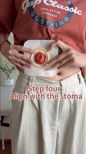 🌟How to Properly Install a Two-Piece Colostomy Pouch?🤪 #ostomy #ostomybag #ostomycare #colostomy