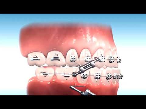 How to correct Class III Malocclusion?