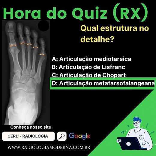 Articulação metatarsofalangeana