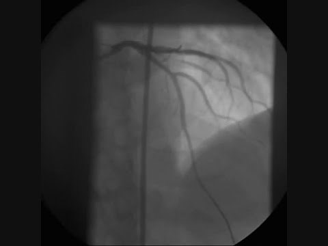 Angioplasty And Stenting Of Left Anterior Descending Coronary Artery