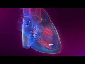 World’s First Dual Chamber Leadless Pacemaker