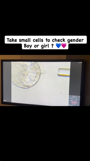 Embryologist Putri on Instagram: "A precise trophectoderm biopsy performed at the blastocyst stage to support accurate chromosomal analysis and embryo selection. Chromosomal analysis through embryo biopsy allows identification of XX or XY, while also screening for genetic abnormalities. #ivf #ivfsuccess #ivfjourney #embryologist #lab"