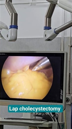 Laparoscopic view of live and gallbladder #medicalshorts #doctorlife #otlife