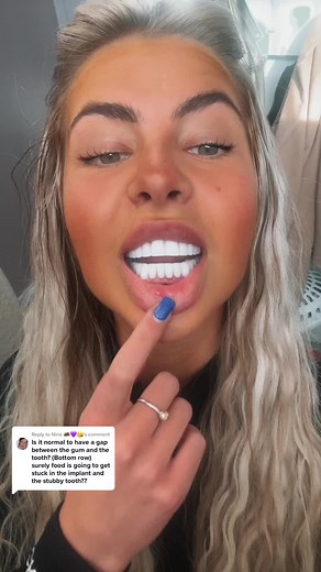 Gum Contouring: A Detailed Guide