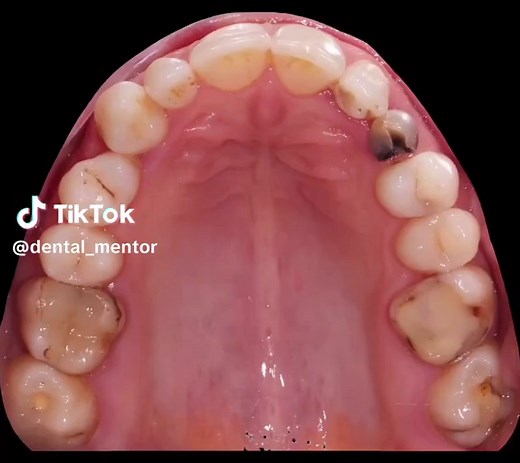 Impacted Canine Exposure Procedure Explained