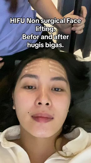 HIFU Non-Surgical Face Lifting Results