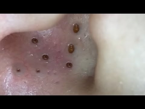 Large Blackheads Cystic Acne Blackheads&Whiteheads Removal Pimple Popping #279