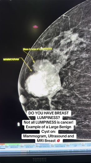 Understanding Breast Cysts: What You Need to Know