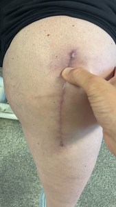 8 Weeks After Total Knee Replacement: What Should Your Incision Look Like? By week 8, your surgical incision should be fully closed and free of scabs. The skin may still be pink or slightly raised, and it’s common to have some sensitivity or numbness along the scar line. Here’s what to expect: • No drainage or open areas • Scar may feel tight, especially during movement • Itchiness is normal — but avoid scratching! • Redness should be fading, not spreading • A smooth, flat scar is starting to fo