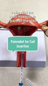When having coil insertion or removal painrelief must always be the plan You should have: - parcetamol 1g & Ibuprofen 400mg (if tolerated) with a little snack, 1hr before the procedure - 10% Lidocaine spray - Cervical block using local anaesthetic - gas and air (entonox) if available