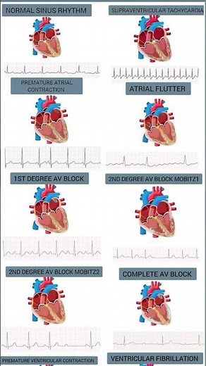 Most common Arrhythmias (heart motion + rhythm strip) #cardiology #medicalstudent #usmle #medstudent