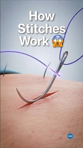 A Stitch in time saves 90,000,00 . Every Year 🩺 #stitches #woundcare