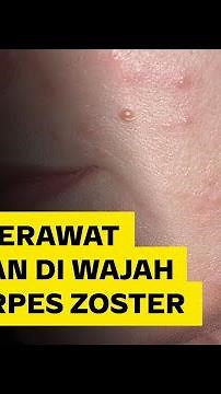 Benjolan di Wajah Dikira Jerawat, Ternyata Herpes Zoster | Narasi Daily