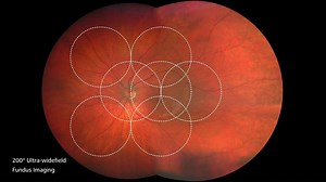 See how you can reveal more with CLARUS (TM) 500, the newest retinal camera from ZEISS: https://zeiss.ly/fb_clarus500 *Not all products / services approved and available in all countries. | ZEISS Medical Technology