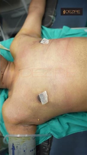 Gynecomastia Surgery