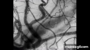 Preserved microcirculation on Make a GIF