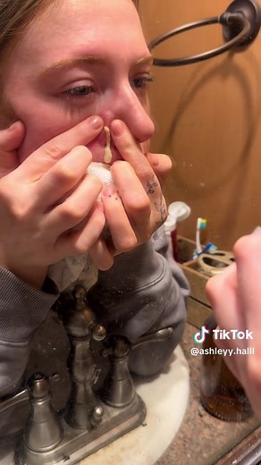 Confronting the Dread of Pimples: A Satisfying Release