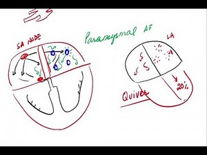 Atrial Fibrillation - Pathophysiology and Clinical