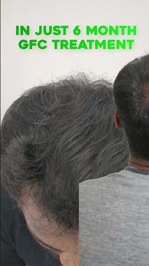 GFC Hair Results Before & After 🤯 Real Transformation