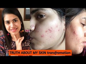 How I cleared my SKIN from ACNE & DARK SPOTS