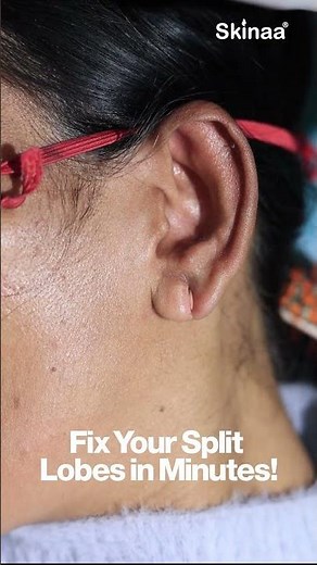 Professional Ear Lobe Repair at Skinaa || #earloberepair #cosmeticprocedure #aestheticclinic