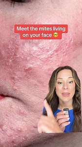 ROSACEA and DEMODEX: what’s the connection? Rosacea is a common condition that looks like acne, but isn’t. It typically occurs later in life and consists of acne-like lesions, redness, skin sensitivity, and broken blood vessels. We know that rosacea is caused by a variety of factors, including both genetic and environmental, but one of the biggest triggers/associations is a response to an abnormal level of mites on our skin called demodex. Demodex can be present on non-rosacea skin but may be 15