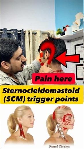 scm muscle release, sternocleido mastoid trigger point, neck pain cause headache, jaw pain physio