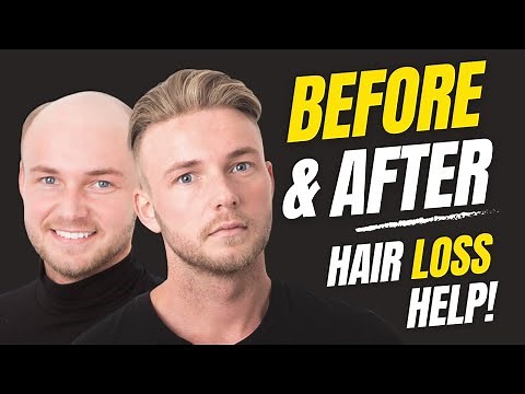 How to Apply (Attach) a Non-Surgical Hair Replacement System for Men with The Harris Brothers UK/USA