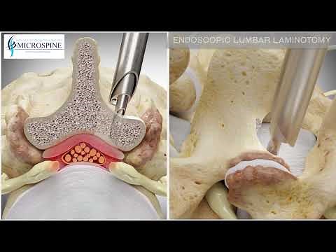 04 Endoscopic Lumbar Decompression