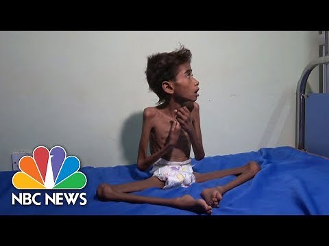 The Face Of Suffering: Famine, Cholera Wreak Havoc In War-Torn Yemen | NBC News