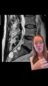 425K views · 3.7K reactions | Case study 139 - Spinal cysts?!? A 36...