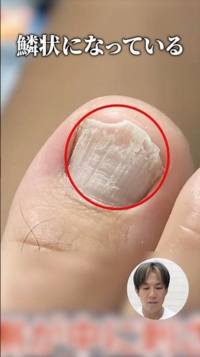 【施術動画】爪が皮膚に刺さる陥入爪とは？巻き爪のプロが実例をもとに解説