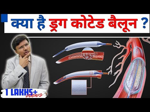 DRUG COATED BALLOON:-Latest Balloon Angioplasty Technique Benefits and issues
