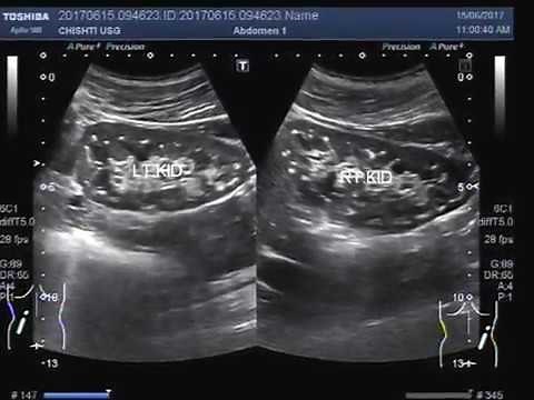 Ultrasound Video showing bilateral renal microlithiasis.