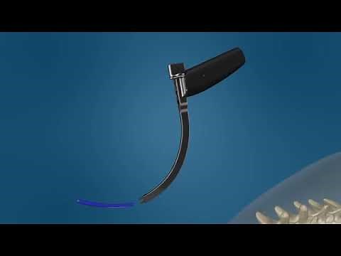 Alphatec Spine: Illico Mininally Invasive Spinal Fusion System