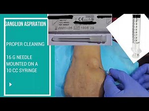 ASPIRATION OF GANGLION CYST OF WRIST AND INJECTION OF TRIAMCINOLONE/ STEROID