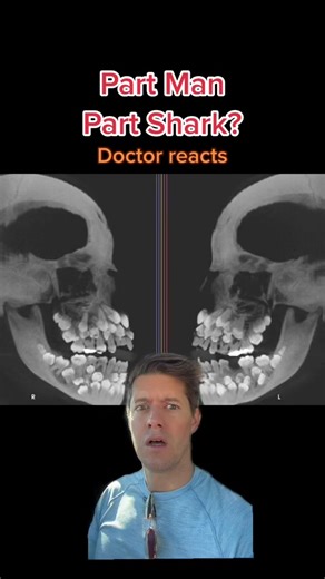 Hyperdontia: A Case of 81 Teeth in a Patient