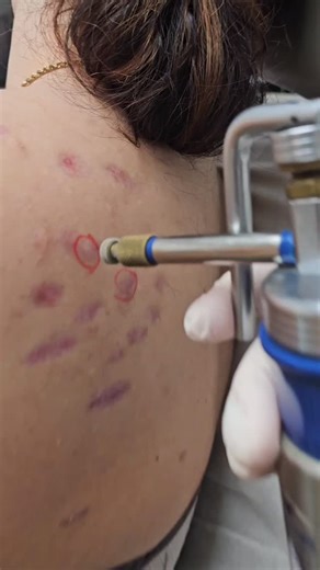Dr. Olga Goulko's Keloid scar removal ⁣ Treatment type: cryosurgery, triamcinolone injections⁣ Pain: numbing injection ⏰Treatment time: 10-15 minutes. May require several treatments⁣. ⁣ ⁣⁣⁣⁣Dermatology & Laser Surgery Center⁣⁣⁣⁣⁣⁣⁣ ✉ info@lasersurgery.net⁣⁣⁣⁣⁣⁣⁣ 🖥 www.lasersurgery.net⁣⁣⁣⁣⁣⁣⁣ 🏢 2125 Center Av. Fort Lee, NJ 07024⁣⁣⁣⁣⁣⁣⁣ ☎ 201-461-5655⁣ ⁣⁣⁣⁣⁣⁣⁣ ⁣⁣⁣⁣⁣ ⁣⁣⁣⁣⁣⁣#cryosurgery #keloidremoval #keloidscar #keloidtreatment #hypertrophy #scar #fortleenj #drolgagoulko #mdskinline | Dermatolog