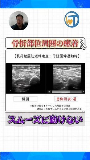 【下腿骨骨折後拘縮で診るべき〇〇筋】拘縮を引き起こす癒着と滑走不良の正体とは？／【セラフォーshort】村野勇先生 #リハビリ #足関節 #shorts