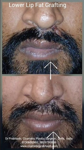 Rhinoplasty Lip Cheek Augmentation Fat Grafting Before After, India, Delhi