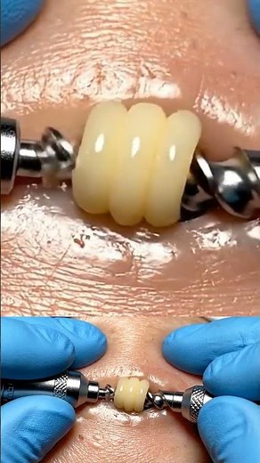 Derm Tech Blackhead Drill Pick Ultra satisfying spiral sebum extraction ASMR