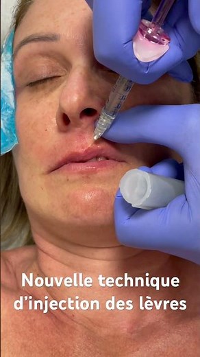 Lip injection with hyaluronic acid @DrHerveRaspaldo #injection #aestheticmedicine