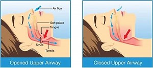 How It Works - Optipillows EPAP Mask