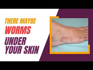 The Horrors Of Cutaneous Larva Migrans